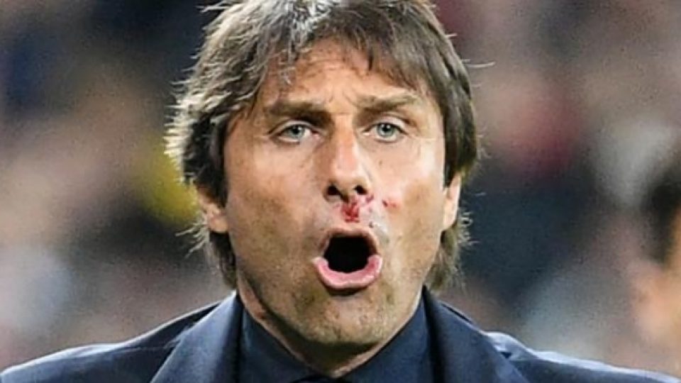 Inilah Penyebab Hidung Conte Mengeluarkan Darah