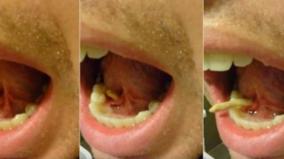 Ajaib, Ada Batu Muncul Di Dalam Mulut Pria Asal AS Ini