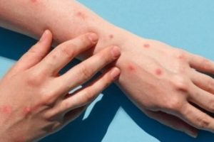 BREAKING: Kemenkens Konfirmasi Pasien Cacar Monyet Pertama di Indonesia, Tepatnya di DKI Jakarta